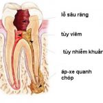 Viêm tủy răng và những điều cần biết về chúng trước khi quá muộn