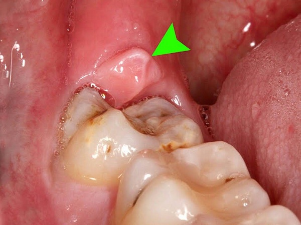 đau nhức răng hàm dưới, đau răng hàm dưới, nhức răng hàm dưới, đau nhức răng hàm trong cùngnhức răng hàm dưới bên phải, nhức răng hàm dưới bên trái, bị nhức răng hàm dưới, đau răng hàm dưới bên phải, bị đau răng hàm dưới, đau răng hàm dưới trong cùng, đau nhức răng, đau răng sâu phải làm thế nào, nhức chân răng hàm dưới, đau răng cấm hàm dưới, đau răng hàm trong cùng, bị đau răng hàm, răng hàm bị sâu đau nhức, đau nhức răng phải làm sao, đau nhức răng sâu, nhức răng trong cùng hàm dưới, đau răng trong cùng hàm dưới, đau sâu răng hàm, nhức răng hàm trên phải làm sao, đau răng cửa hàm dưới, sâu răng hàm dưới trong cùng