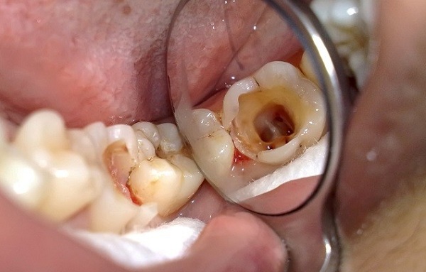 đau nhức răng hàm dưới, đau răng hàm dưới, nhức răng hàm dưới, đau nhức răng hàm trong cùng, nhức răng hàm dưới bên phải, nhức răng hàm dưới bên trái, bị nhức răng hàm dưới, đau răng hàm dưới bên phải, bị đau răng hàm dưới, đau răng hàm dưới trong cùng, đau nhức răng, đau răng sâu phải làm thế nào, nhức chân răng hàm dưới, đau răng cấm hàm dưới, đau răng hàm trong cùng, bị đau răng hàm, răng hàm bị sâu đau nhức, đau nhức răng phải làm sao, đau nhức răng sâu, nhức răng trong cùng hàm dưới, đau răng trong cùng hàm dưới, đau sâu răng hàm, nhức răng hàm trên phải làm sao, đau răng cửa hàm dưới, sâu răng hàm dưới trong cùng