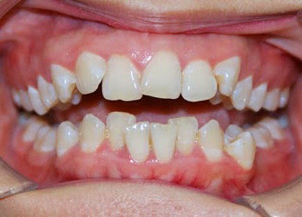răng lệch lạc nên niềng hay bọc sứ, răng lệch, răng lệch lạc, niềng răng lệch lạc, niềng răng lệch lạc là gì, sửa răng lệch, răng lệch lạc chữa thế nào, niềng răng lệch lạc mất bao lâu, giá chỉnh răng lệch lạc