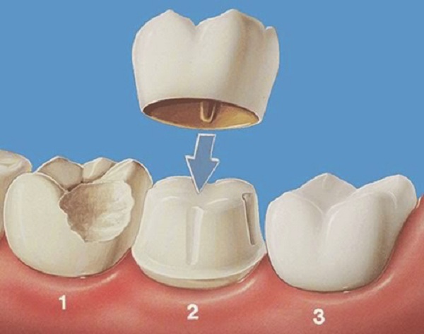 hàn răng mẻ,hàn răng bị mẻ,răng mẻ có hàn được không,răng sứt mẻ có hàn được không,hàn răng mẻ có đau không,hàn răng cửa bị mẻ,răng sứt mẻ có hàn được không,răng bị mẻ có hàn được không,răng mẻ ê buốt,răng mẻ có trám được không,răng mẻ bị nhức, răng mẻ thiếu chất gì,răng mẻ bị buốt,răng bị mẻ thì nên làm gì,răng bị mẻ lớn,răng bị mẻ đau nhức,răng bị mẻ ở chân răng,răng bị mẻ và lung lay