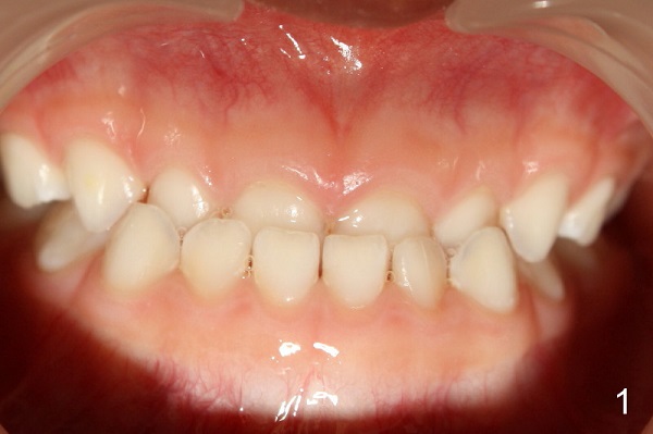 chỉnh hình răng quặp vào, răng quặp, răng quặp ki bo, răng cửa quặp vào trong, chữa răng quặp, răng quặp có ý nghĩa gì, răng quặp là gì, xem tướng răng quặp, răng quặp là như thế nào, người răng quặp, niềng răng quặp, răng quặp vào trong, tướng răng quặp, đàn ông răng quặp, phụ nữ răng quặp, răng cụp vào trong, chữa răng quặp, răng quặp có niềng được không, răng quắp vào, răng cụp, niềng răng quặp, răng bị cụp vào trong, răng bị quặp vào trong