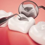 Sâu răng phát triển như thế nào | Cách điều trị sâu răng