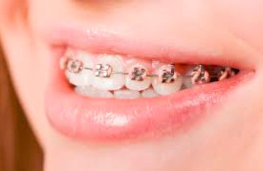 Niềng răng có phải nhổ răng khôn không? Chia sẻ từ chuyên gia