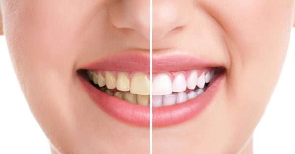 Chữa sâu răng tận gốc bằng cách nào