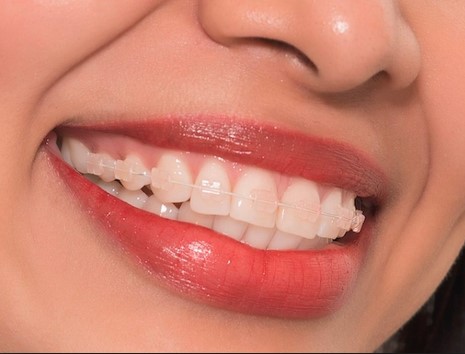 Niềng răng trong suốt trả góp có được áp dụng tại nha khoa không?