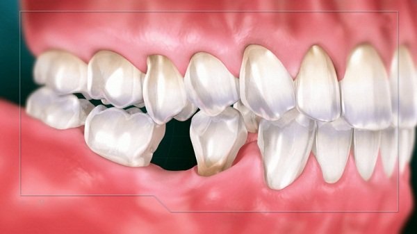 nhổ răng số 6, nhổ răng số 6 hết bao nhiêu tiền, nhổ răng số 6 hàm dưới, nhổ răng số 6 có nguy hiểm không, tác hại của việc nhổ răng số 6, nhổ răng số 6 hàm trên,nhổ răng số 6 bao lâu thì lành,niềng răng nhổ răng số 6