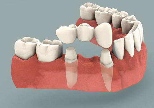  bọc sứ răng hàm, bọc sứ răng hàm trên, bọc sứ răng hàm mặt, quy trình bọc sứ răng hàm