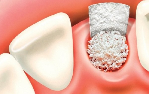 màng trắng sau khi nhổ răng, màng trắng sau khi nhổ răng là gì, xuất hiện màng trắng sau khi nhổ răng, dấu hiệu nhiễm trùng sau khi nhổ răng, sưng nướu sau khi nhổ răng, nhổ răng bị mưng mủ, nhiễm trùng, nhiễm trùng sau khi nhổ răng, nhiễm trùng sau nhổ răng, mảng trắng sau nhổ răng, chỗ nhổ răng có màu trắng, vết nhổ răng có màng trắng, ổ răng sau nhổ có mùi hôi, nhổ răng bị nhiễm trùng, nhổ răng khôn bị nhiễm trùng, dấu hiệu bị nhiễm trùng khi nhổ răng khôn, dấu hiệu nhiễm trùng sau khi nhổ răng khôn, dấu hiệu của nhiễm trùng răng, dấu hiệu viêm nhiễm sau nhổ răng