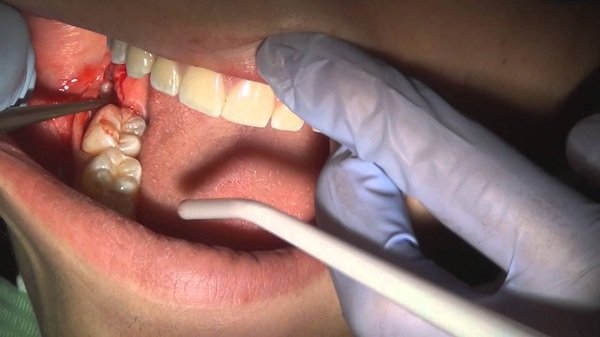 màng trắng sau khi nhổ răng, màng trắng sau khi nhổ răng là gì, xuất hiện màng trắng sau khi nhổ răng, dấu hiệu nhiễm trùng sau khi nhổ răng, sưng nướu sau khi nhổ răng, nhổ răng bị mưng mủ, nhiễm trùng, nhiễm trùng sau khi nhổ răng, nhiễm trùng sau nhổ răng, mảng trắng sau nhổ răng, chỗ nhổ răng có màu trắng, vết nhổ răng có màng trắng, ổ răng sau nhổ có mùi hôi, nhổ răng bị nhiễm trùng, nhổ răng khôn bị nhiễm trùng, dấu hiệu bị nhiễm trùng khi nhổ răng khôn, dấu hiệu nhiễm trùng sau khi nhổ răng khôn, dấu hiệu của nhiễm trùng răng, dấu hiệu viêm nhiễm sau nhổ răng