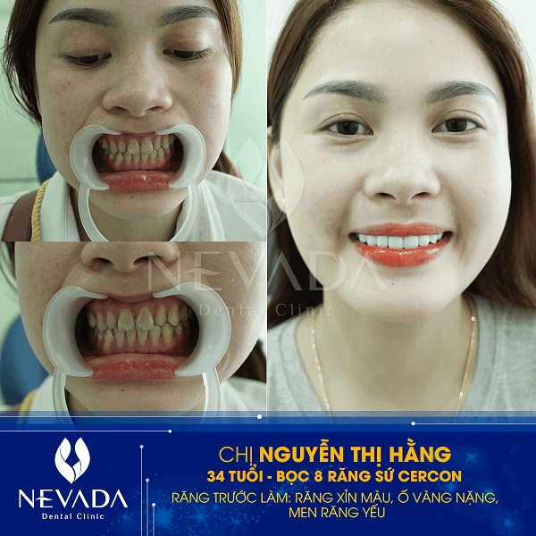 Khách hàng thực hiện mài răng – bọc sứ tại Nha khoa Nevada