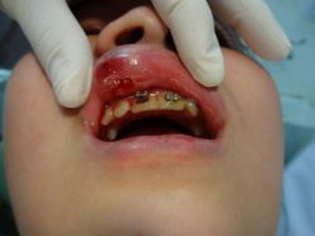 niềng răng có làm mũi cao lên, niềng răng mũi có cao lên không,đang niềng răng có nâng mũi được không, niềng răng có giúp mũi cao hơn không