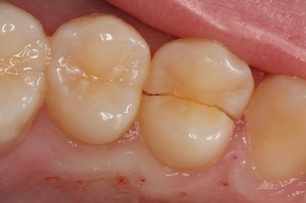 hiện tượng răng bị nứt nên làm gì, răng bị nứt, răng bị nứt có tự lành, răng bị nứt nhẹ, răng bị nứt vỡ, răng bị nứt nên làm gì, hiện tượng răng bị nứt, răng bị nứt đôi, tại sao răng bị nứt, răng bị nứt có sao không, răng bị nứt phải làm sao, răng bị nứt có trám được không, răng bị nứt chân, răng bị nứt có lành lại không, răng bị nứt nẻ, răng bị nứt làm sao, răng bị rạn nứt, chân răng bị nứt, xử lý răng bị nứt, cách điều trị răng bị nứt, cách khắc phục răng bị nứt, nguyên nhân răng bị nứt