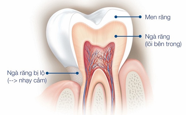 răng nhạy cảm, răng nhạy cảm là gì, điều trị răng nhạy cảm, cách chữa bệnh răng nhạy cảm, cách chữa răng nhạy cảm, triệu chứng răng nhạy cảm, biểu hiện của răng nhạy cảm, nguyên nhân răng nhạy cảm